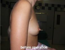 plastic-surgery-breast-augmentation 